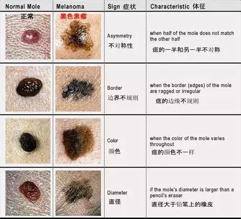 為什麼會長黑痣|皮內痣：症狀、病因及如何治療